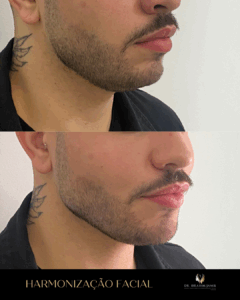 harmonização facial florianópolis
