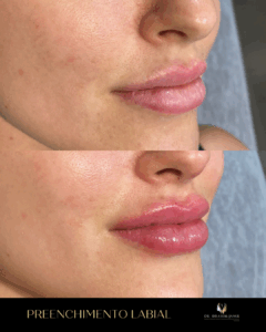 harmonização facial florianópolis