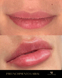harmonização facial florianópolis