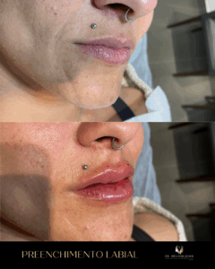 harmonização facial florianópolis