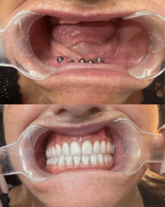 Implante dentário realizado por Dr. Ibrahim Jamil em Florianópolis